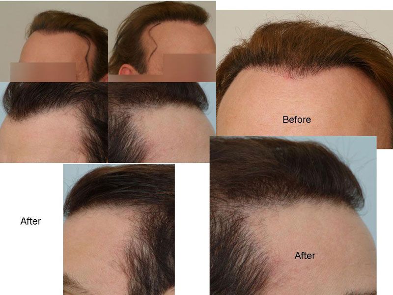 Hairline After Zps551c473e Hairline After Zps551c473e