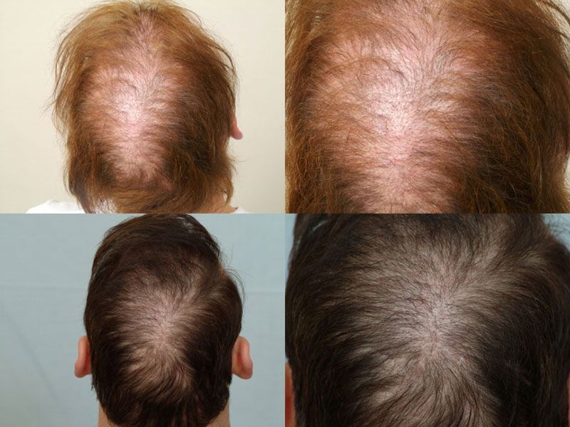 Red Body Hair Zpsb9b1b648 Red Body Hair Zpsb9b1b648